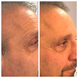 Esthetics By Natalie - Endermologie for the face after first visit
