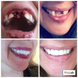 DDS Dentures & Implant Solutions - This photo may be graphic and has no filter. It is my own personal property. Pic is from beginning of accident, to end result!
