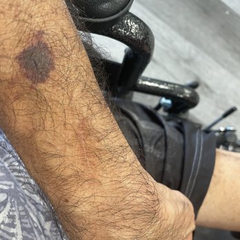 Pelican Ridge Post Acute - Woke up w a nasty bruise! - Rehabilitation Center Near Me - Newport Beach, California