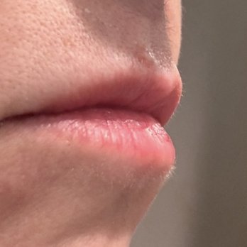 Spa Black North - Lip injection migrates around mouth and not on lips - Medical Spas Near Me - San Antonio, Texas Spa Black North - Lip injection migrates around mouth and not on lips - Medical Spas Near Me - San Antonio, Texas
