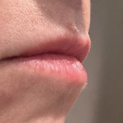 Spa Black North - Lip injection migrates around mouth and not on lips