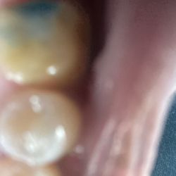 Blue Ash Dental Group - Tooth