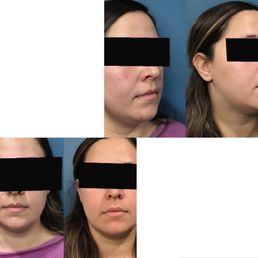 Left are before the micro needling and left 10 day follow up  appointment.