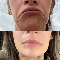 Atelier Medical Aesthetics - Lower face neurotoxin treatment for prevention of jowling and pulling of the lower face