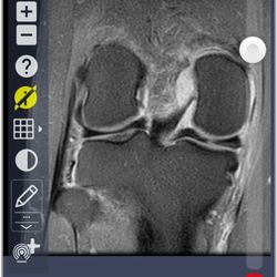 Newport Diagnostic Center - Medial meniscus tear