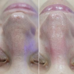 Forever Flawless Aesthetics - Blackhead removal with a Deluxe HydraFacial.