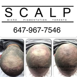 Scalp Micropigmentation Center - Scalp Micropigmentation Center Results and Reviews of Tino Barbone.