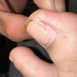 Nails - The image depicts a close-up of a fingernail with damaged nail polish that is peeling and chipped. The nail has a light pink base color with a gold glitter tip, and the surrounding skin appears slightly dry. The nail's surface shows signs of wear, with visible cracks and uneven edges, indicating possible nail or polish damage.