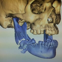 Clifton Center for Oral Surgery & Jaw Reconstruction - Gun shot to lower jaw