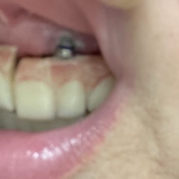 Dental Express - Left side top plate - Cosmetic Dentists Near Me - Ajijic, JAL