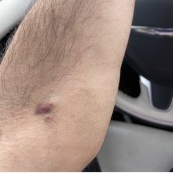 Vida-Flo Buckhead - IV Hydration - I was stuck 3 times in my AC to finally get the vein - notice the severe bruising. I get weekly IV treatments.
