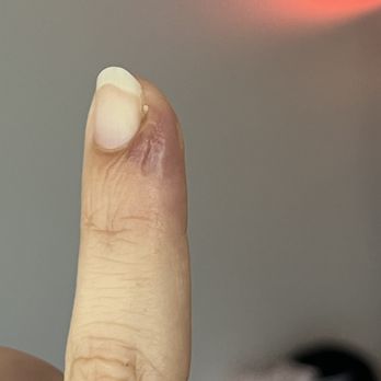 JoJo Nails - healing took months and fingertip looked like it was decaying off - Nail Salons Near Me - Costa Mesa, California JoJo Nails - healing took months and fingertip looked like it was decaying off - Nail Salons Near Me - Costa Mesa, California