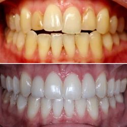 Union Square Dental Practice - Invisaling and two veneers to help with open bite
