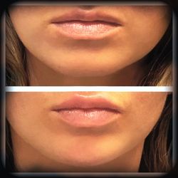 Restorative Health of North Georgia - Lip Filler