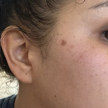 Imperial Dermatology - Before - Dermatologists Near Me - Brea, California
