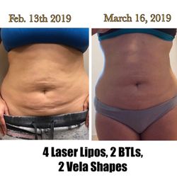 Orlando Laser Lipo Services - Rosie's starting  treatments