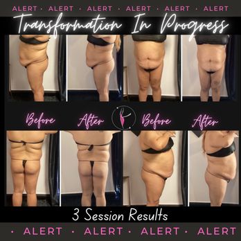 Snatched BodyWorks - Body Contouring Near Me - Burleson, Texas Snatched BodyWorks - Body Contouring Near Me - Burleson, Texas