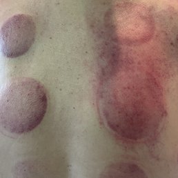 I think it's clear where the cupping went wrong...