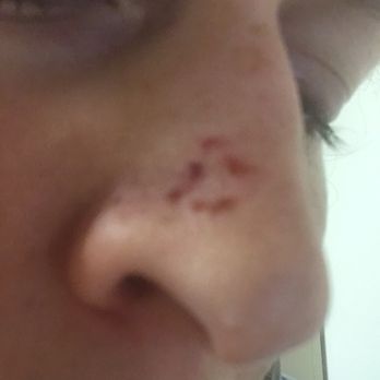 Kits Spa - My scabby noes after a facial - Massage Near Me - Vancouver, British Columbia Kits Spa - My scabby noes after a facial - Massage Near Me - Vancouver, British Columbia
