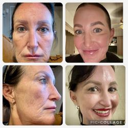Andrew J. Miller, MD - Associates In Plastic Surgery - 3 month update