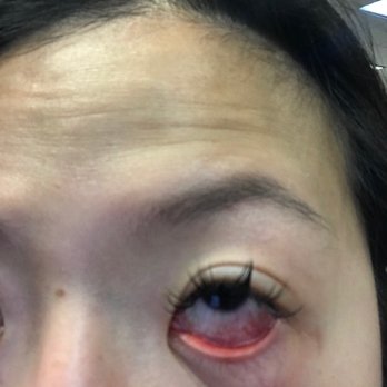 MIJI Beauty Eyelashes - 6 hours later... Super irritated with clear discharge that lasted 2 days. - Eyelash Service Near Me - San Gabriel, California MIJI Beauty Eyelashes - 6 hours later... Super irritated with clear discharge that lasted 2 days. - Eyelash Service Near Me - San Gabriel, California