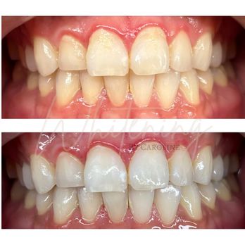 Whitening by Caroline - Brightening up a smile before a wedding - Teeth Whitening Near Me - Los Alamitos, California Whitening by Caroline - Brightening up a smile before a wedding - Teeth Whitening Near Me - Los Alamitos, California