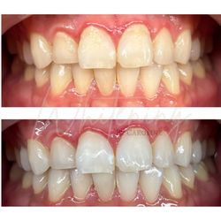 Whitening by Caroline - Brightening up a smile before a wedding