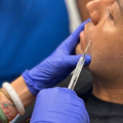 Recharge Lab - Nasoloabial Dermal Filler