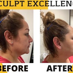 Sculpt Excellence - Facial Results