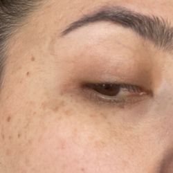 Jmarie Skin Studio - Blotchiness from the chemical peel.