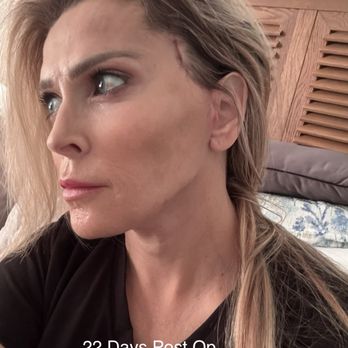 ARC Plastic Surgery: Jeremy White, M.D - 22 days post op - Cosmetic Surgeons Near Me - Miami, Florida ARC Plastic Surgery: Jeremy White, M.D - 22 days post op - Cosmetic Surgeons Near Me - Miami, Florida