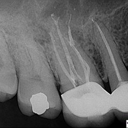 Precision Endodontics, PC - Root Canal - CBCT 3D Imaging