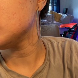 Inflamed and burned marks on cheeks and chin....beware!!!!! Inflamed and burned marks on cheeks and chin....beware!!!!!