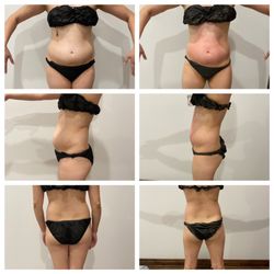 Virtue Holistic Skin Studio  - Before and after (just one session) Pure Body Sculpting