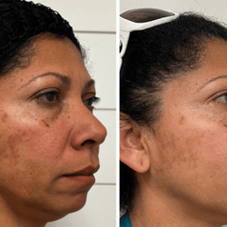 Soul Serenity Beauty & Wellness - (Assuming this is a facial/treatment close-up) Skin Rejuvenation in action! Addressing fine lines and texture with professional care. Book a