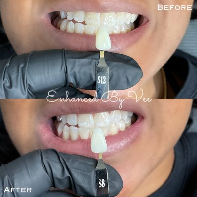 Teeth Whitening - Teeth Whitening is offered in 40, 60 & 90 minute sessions. Teeth Whitening - Teeth Whitening is offered in 40, 60 & 90 minute sessions.