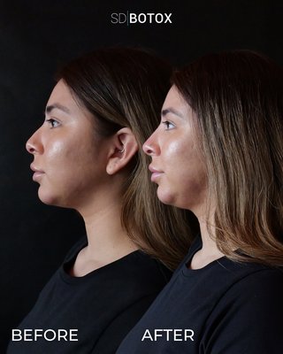 Non-Surgical Nose Job - Dr. Alex Roher has transformed hundreds of noses and profiles since he began his aesthetics career in 2011. Nose fillers, also known as a non-surgical nose job or liquid rhinoplasty, have become increasingly popular as a way to enhance the appearance of the nose without undergoing surgery. A non-surgical nose job provides instant gratification, and immediate results. The procedure is relatively quick and painless, with most patients experiencing minimal discomfort during the injection process. Non-Surgical Nose Job - Dr. Alex Roher has transformed hundreds of noses and profiles since he began his aesthetics career in 2011. Nose fillers, also known as a non-surgical nose job or liquid rhinoplasty, have become increasingly popular as a way to enhance the appearance of the nose without undergoing surgery. A non-surgical nose job provides instant gratification, and immediate results. The procedure is relatively quick and painless, with most patients experiencing minimal discomfort during the injection process.