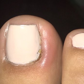 I Love Nails - Infected Cut from pedicure - Nail Salons Near Me - Corona, California