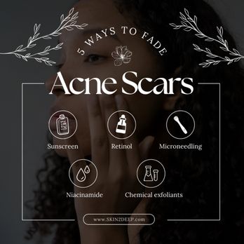 Skin 2 Deep - 5 Ways to Fade Acne Scars! - Laser Hair Removal Near Me - Fairview, Texas Skin 2 Deep - 5 Ways to Fade Acne Scars! - Laser Hair Removal Near Me - Fairview, Texas