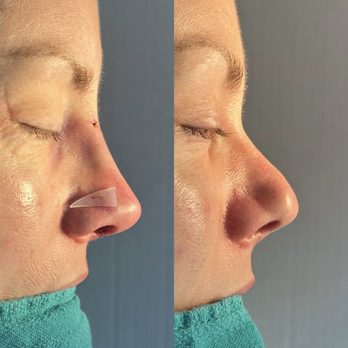 Eos Rejuvenation - On the table results - Cosmetic Surgeons Near Me - Beverly Hills, California Eos Rejuvenation - On the table results - Cosmetic Surgeons Near Me - Beverly Hills, California