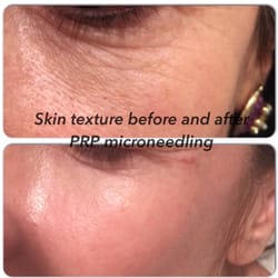Beauty Religion - Skin texture is dramatically improved after 4 treatments with PRP injections and microneedling. Amazing!