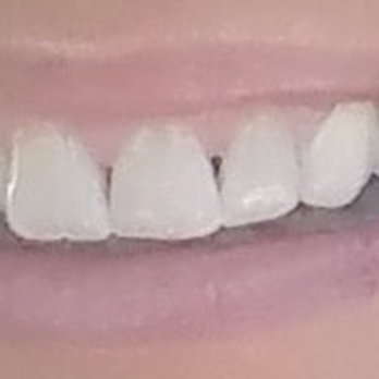 Gently White - After - Teeth Whitening Near Me - Rocklin, California Gently White - After - Teeth Whitening Near Me - Rocklin, California