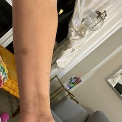 Broward Sheriff's Office - Bruises from Deputy Steven Davis - excessive force