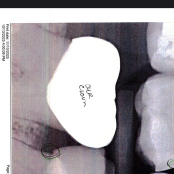 Holistic Life Dentistry - You can see the gap in my crown she set which is clearly why it came off. Can't floss that folks! - Cosmetic Dentists Near Me - Littleton, Colorado Holistic Life Dentistry - You can see the gap in my crown she set which is clearly why it came off. Can't floss that folks! - Cosmetic Dentists Near Me - Littleton, Colorado