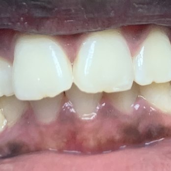 Chicago All Care Dental Group - Before photo - General Dentistry Near Me - Chicago, Illinois