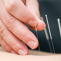 SDR Healing Acupuncture - Acupuncture with very thin needles