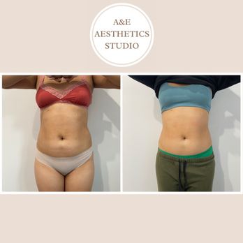 A&E Aesthetics Studio - 2nd session results from our tummy treatment - Body Contouring Near Me A&E Aesthetics Studio - 2nd session results from our tummy treatment - Body Contouring Near Me