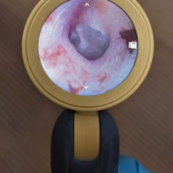 Ascent Audiology & Hearing - Fort Lauderdale - Before: Left war wax removal