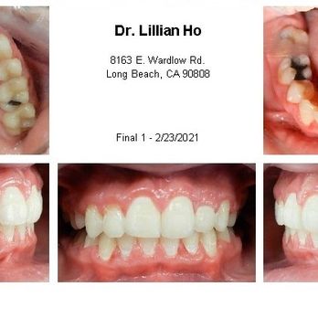 Orthodontics R Us - E.S. After - Orthodontists Near Me - Long Beach, California