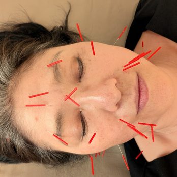 Integrative Healing Arts Acupuncture - Acupuncture Facial Rejuvenation, non-surgical facelift. - Acupuncture Near Me - New York, New York Integrative Healing Arts Acupuncture - Acupuncture Facial Rejuvenation, non-surgical facelift. - Acupuncture Near Me - New York, New York